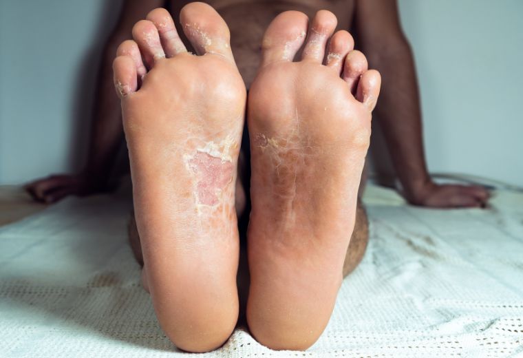 Can Sudocrem Be Used for Fungal Infections?