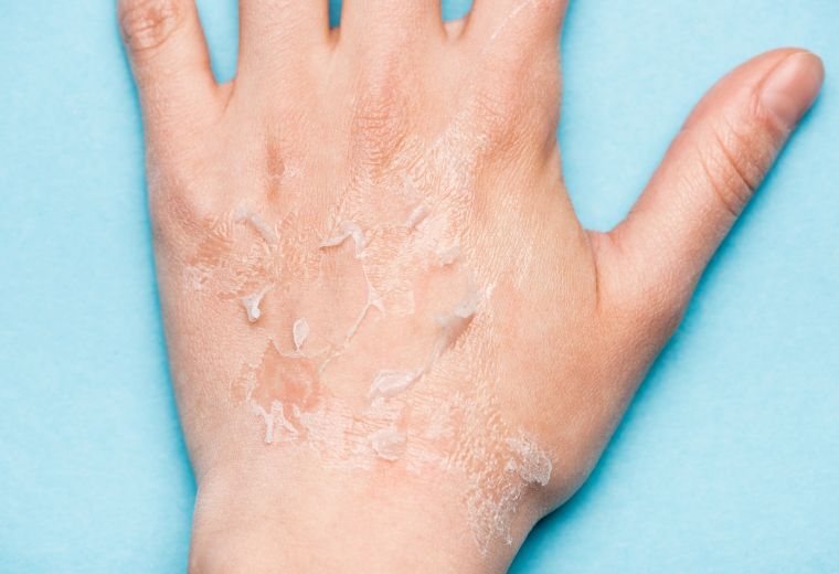 Where to Buy Hydromol Ointment